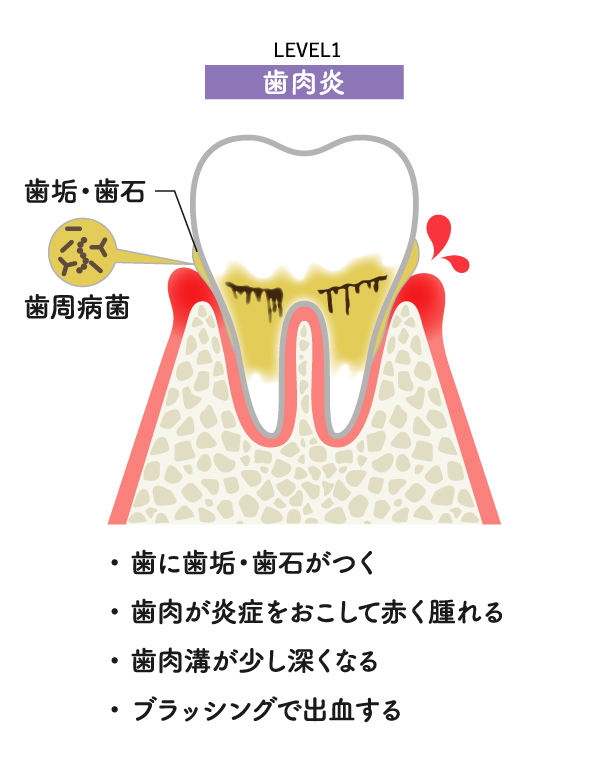 歯周病レベル1