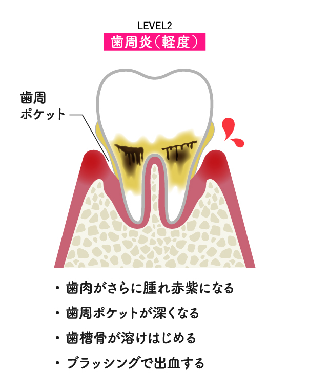 歯周病レベル2