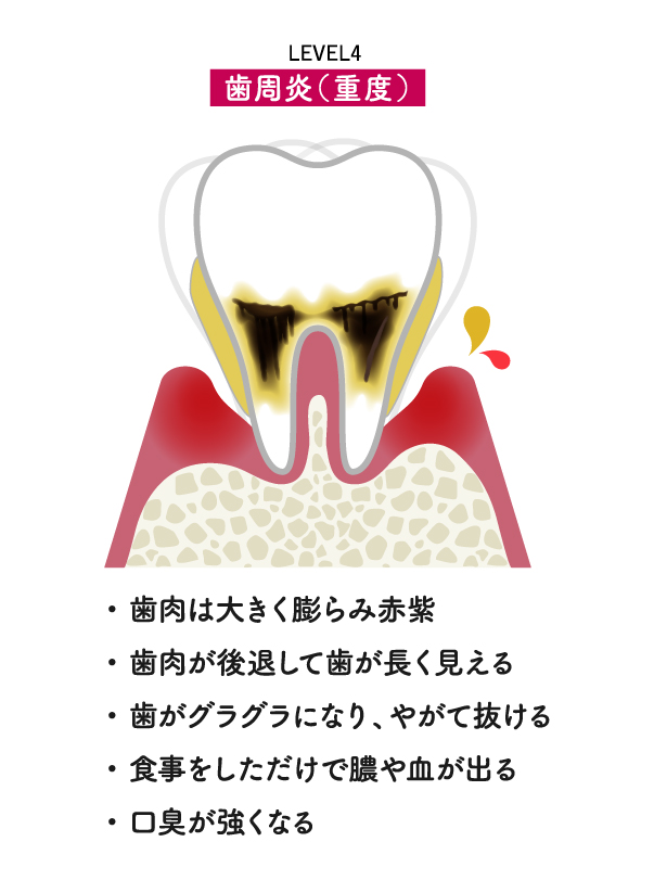 歯周病レベル4
